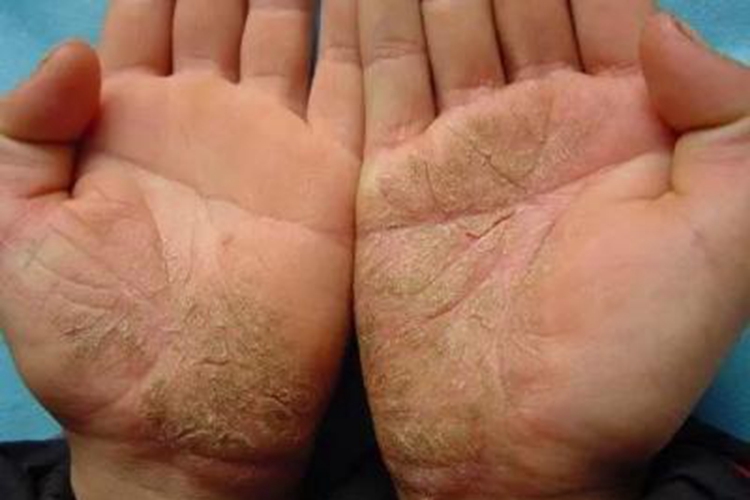 慢性湿疹裂口图 慢性湿疹裂口图