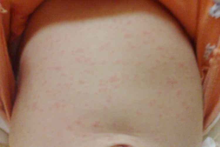 幼儿急疹图