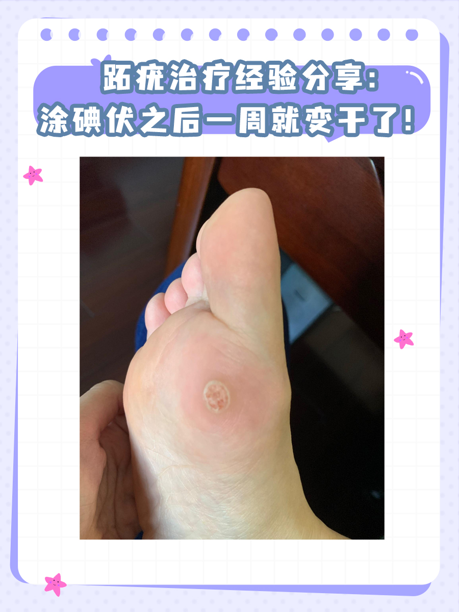 跖疣治疗经验分享：涂碘伏之后一周就变干了！