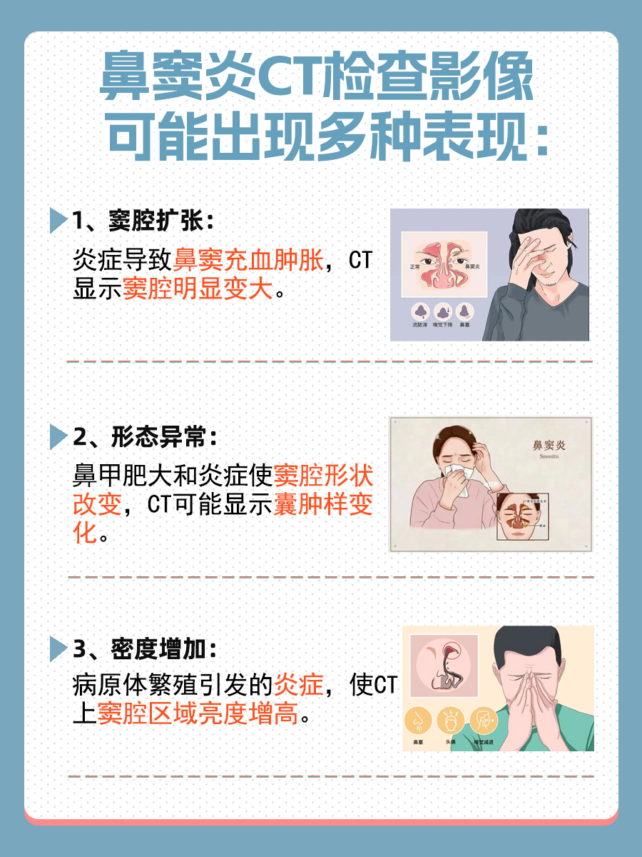 鼻窦炎CT检查影像表现：看这几点你就明白了