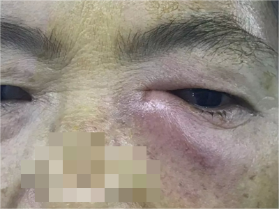 泪囊肿瘤下眼睑起了一个包发红图.png