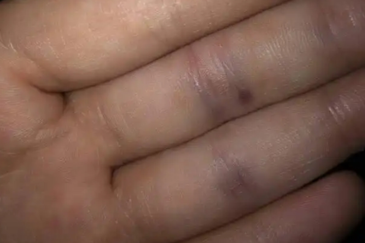 血管挫伤手指关节血管青紫色图