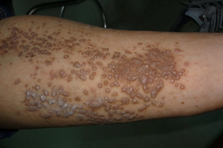 苔藓状淀粉样变小腿疙瘩图 苔藓状淀粉样变小腿疙瘩图