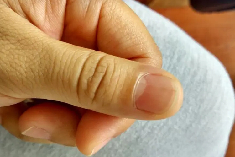 营养不良指甲棕色线图