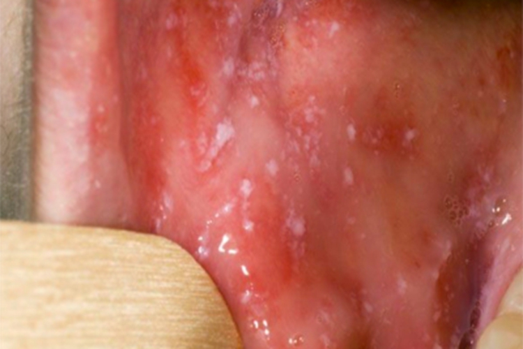 典型麻疹前驱期口腔症状图