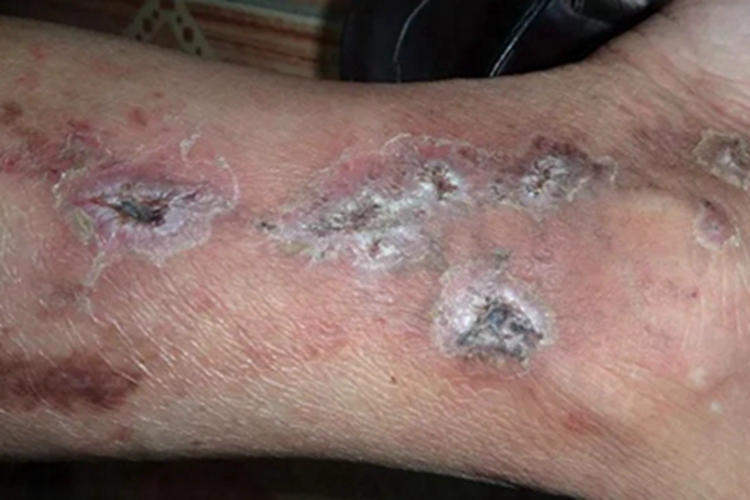 硬红斑小腿结灰白色痂图