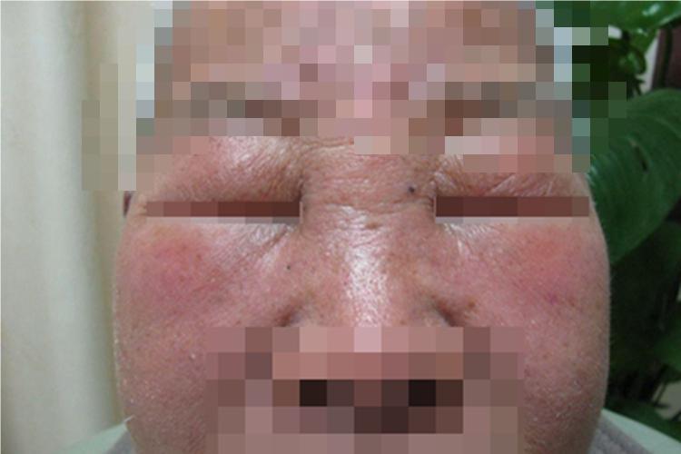 获得性血管性水肿症状图