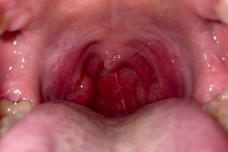 急性咽炎咽喉两侧红肿充血图