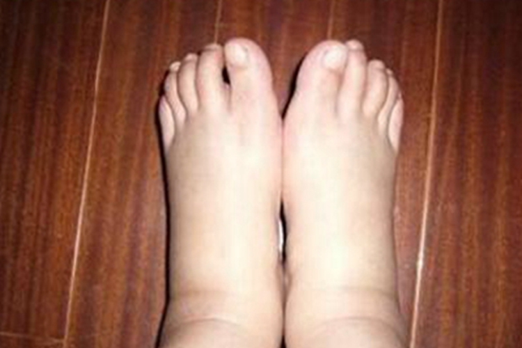 淋巴丝虫病双脚水肿图