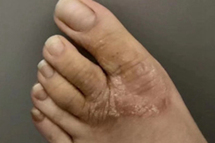 干性湿疹脚背脱屑图 干性湿疹脚背脱屑图