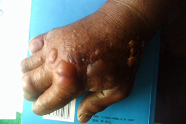 皮肤炭疽手背上有水疱图 皮肤炭疽手背上有水疱图