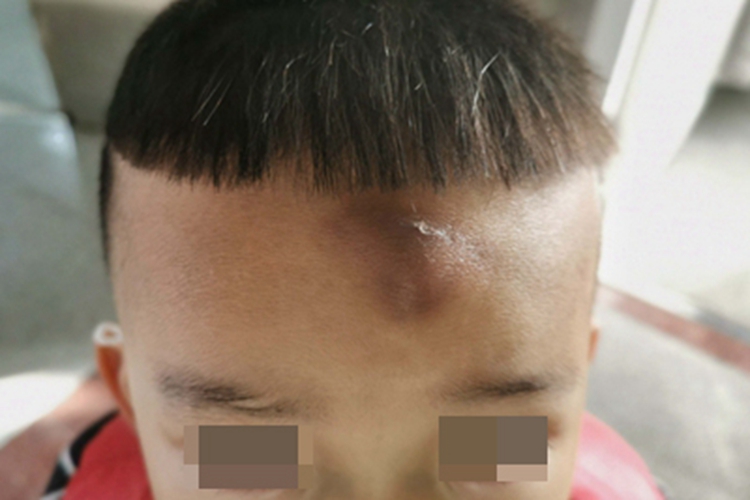皮下血肿前额症状图