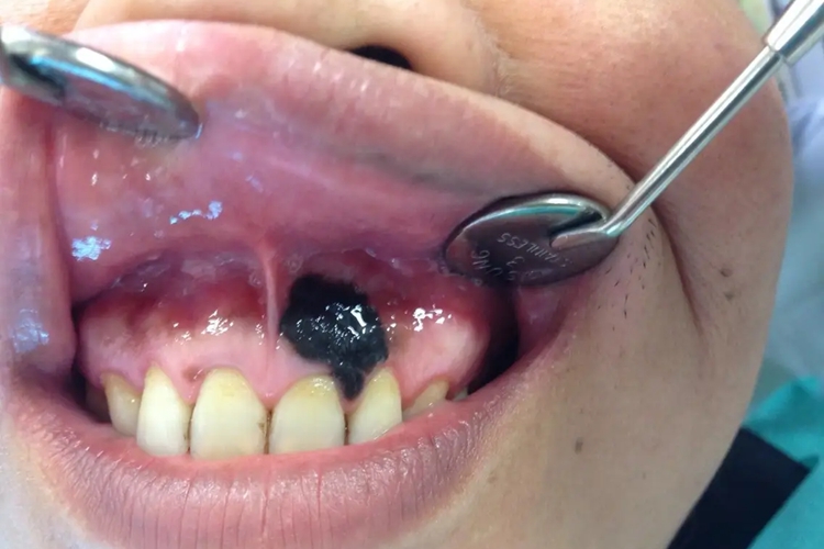 口腔黑色素瘤图