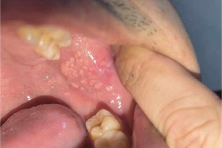 皮脂腺异位症口腔小疙瘩图 皮脂腺异位症口腔小疙瘩图