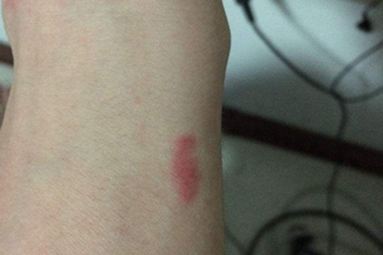 球孢子菌病胳膊疙瘩图