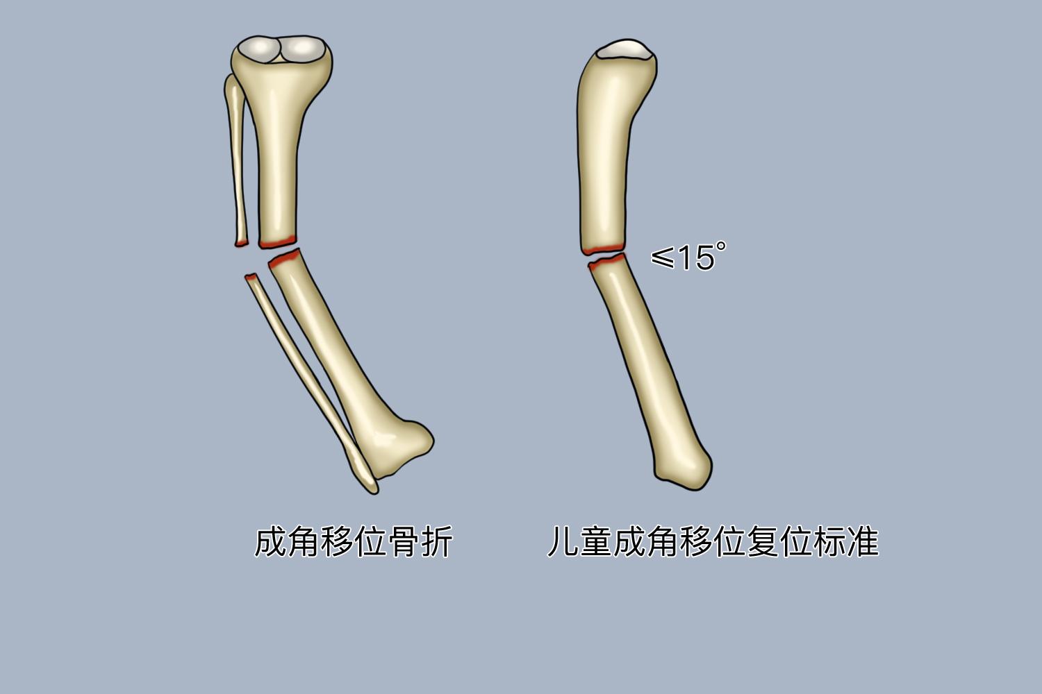 儿童成角移位复位标准图