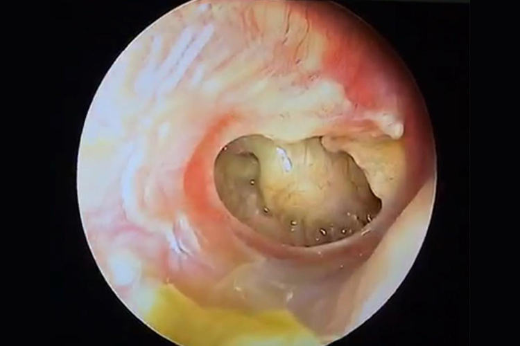 慢性化脓性中耳炎耳膜穿孔图