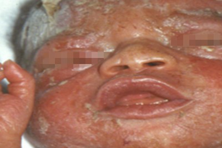 颌面部先天性梅毒症状图 颌面部先天性梅毒症状图