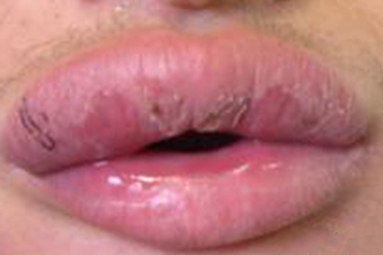 肉芽肿性唇炎水肿图