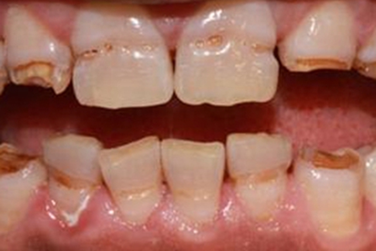 牙釉质发育不全出现大坑图