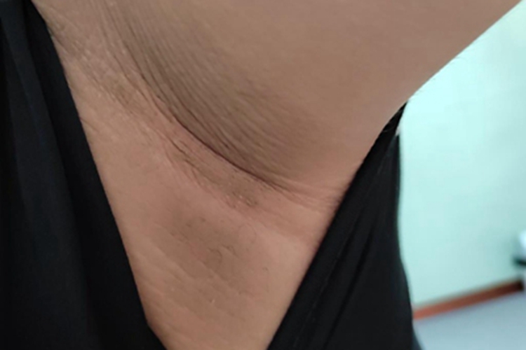 假性黑棘皮病腋窝有黑皱纹图