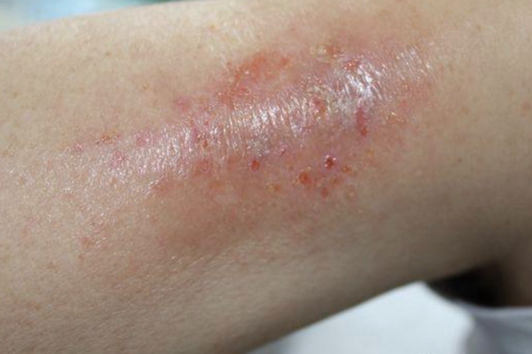 湿疹胳膊渗液图 湿疹胳膊渗液图