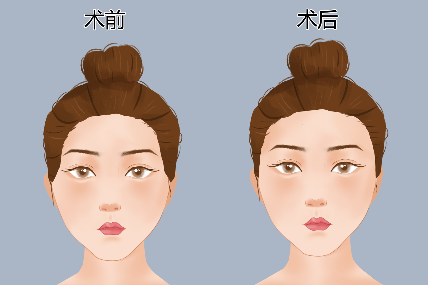 颞部填充手术对比图