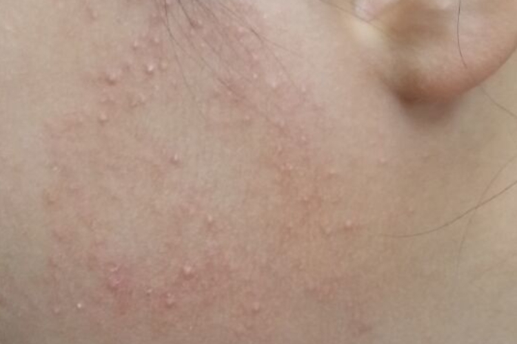 两侧面颊部毛周角化症图 两侧面颊部毛周角化症图