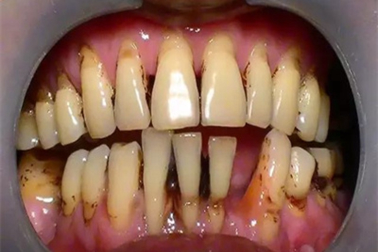 牙龈炎口腔上下牙龈萎缩图