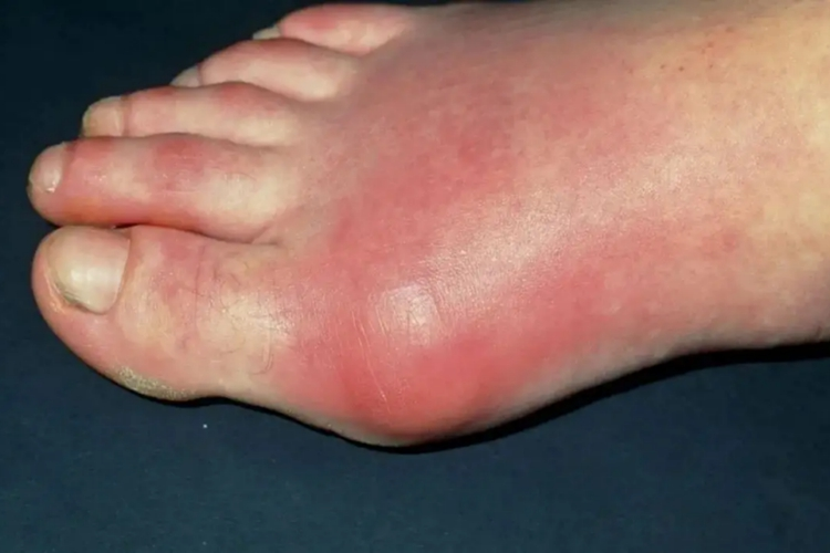 痛风初期脚部红肿图