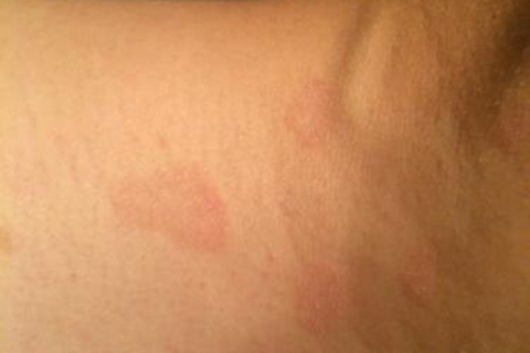 成人Still病颈部症状图