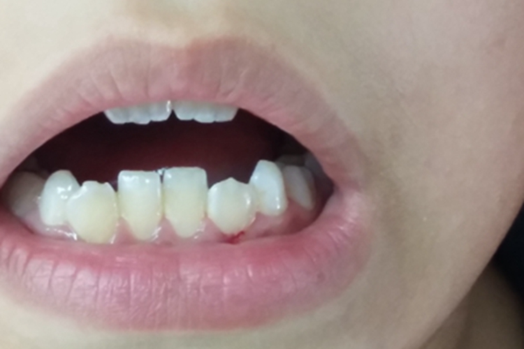 撞伤牙龈症状图