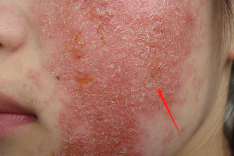 吃柿子过敏变应性皮炎图 吃柿子过敏变应性皮炎图