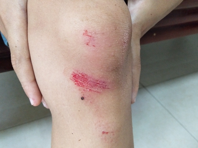 跌伤膝盖有线状排列的擦痕伴红肿图.jpg