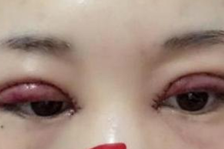 双眼皮肿图