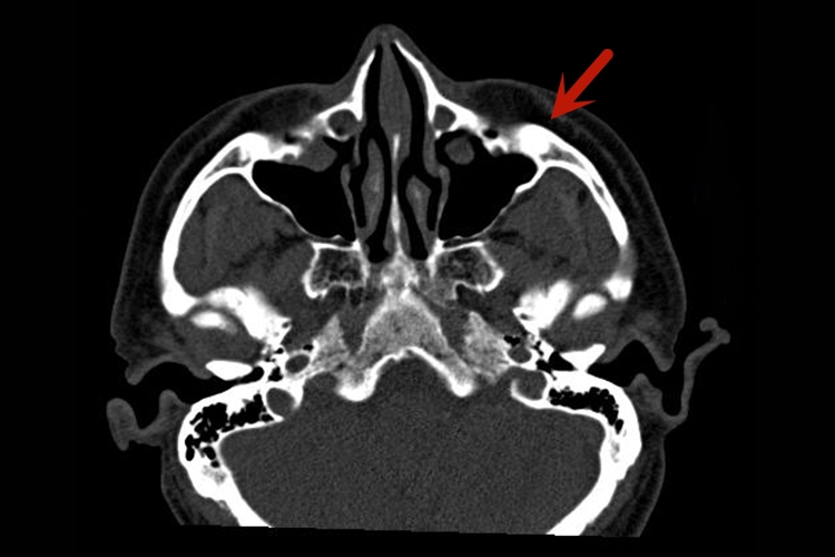 正常颌面部CT上颌骨图 正常颌面部CT上颌骨图