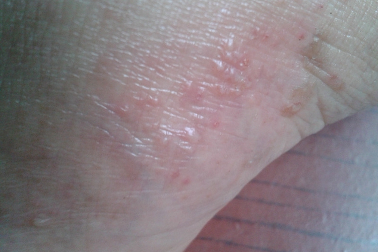 脚底急性湿疹图