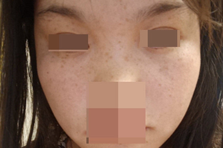 雀斑脸上满布褐色斑点图