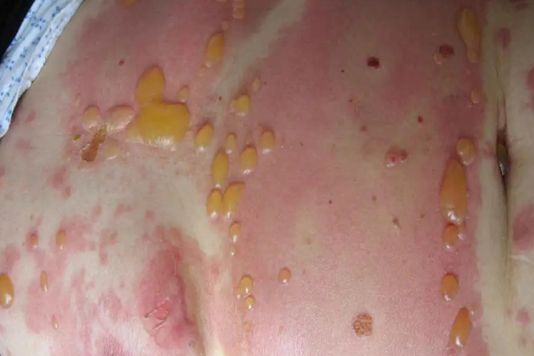 大疱性类天疱疮图 大疱性类天疱疮图