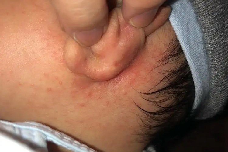 宝宝耳朵后接触性皮炎图