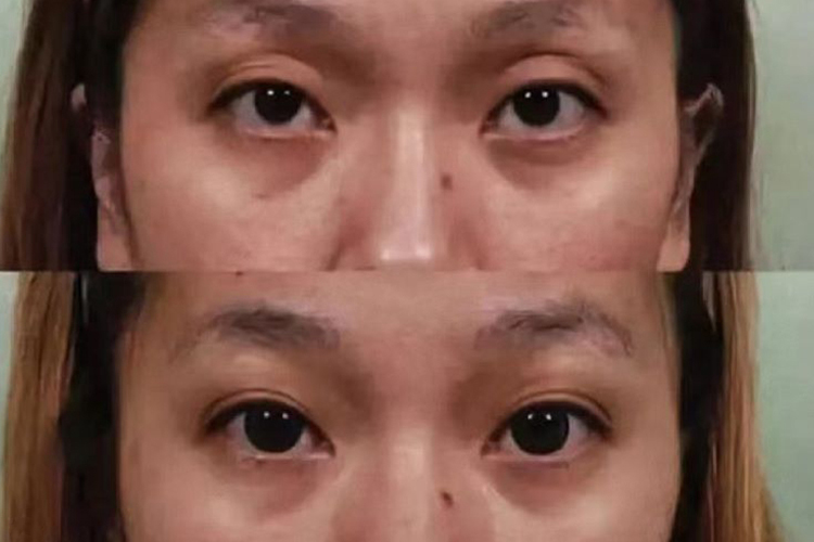 眼窝深割双眼皮的效果图