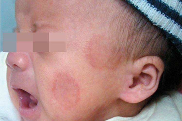 新生儿红斑狼疮面部症状图 新生儿红斑狼疮面部症状图