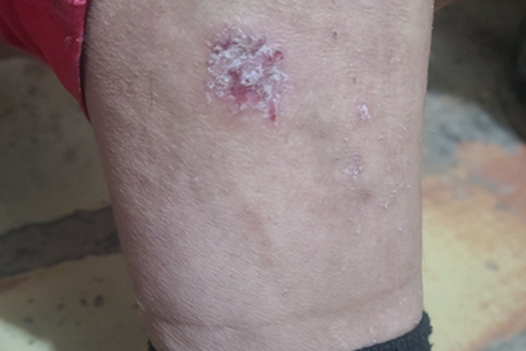银屑病小腿脱屑图 银屑病小腿脱屑图