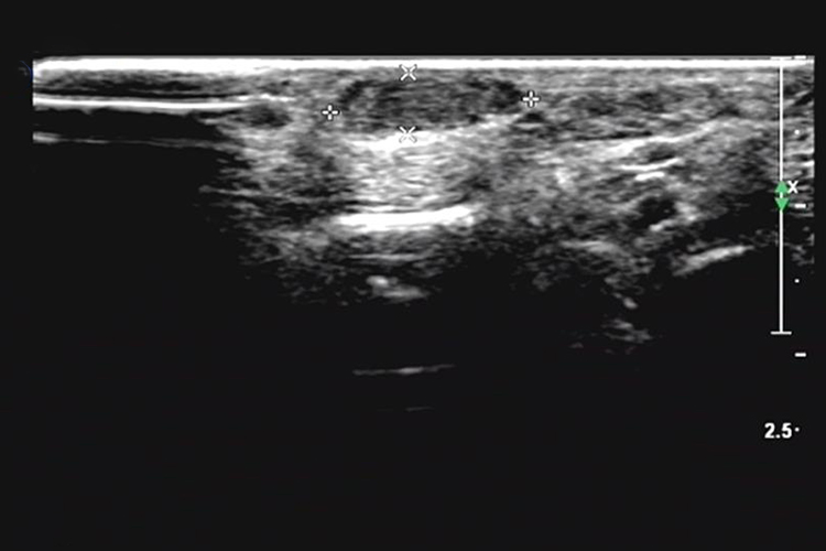 毛细血管瘤超声图 毛细血管瘤超声图