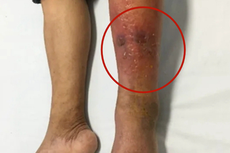 急性网状淋巴管炎水疱图 急性网状淋巴管炎水疱图