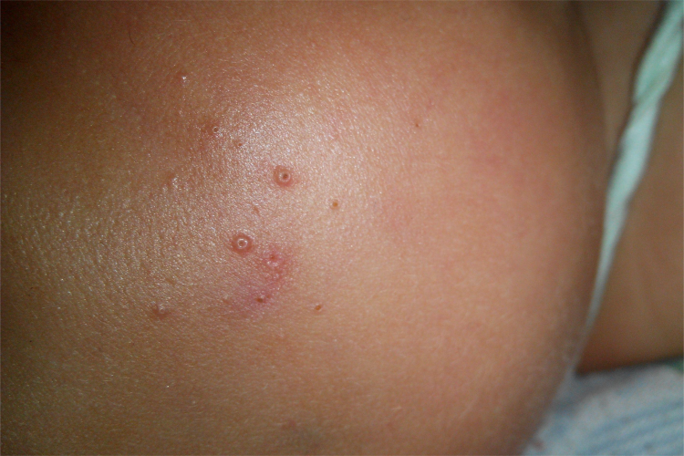 小孩传染性软疣脸上疙瘩图