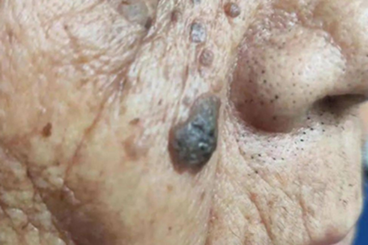 光化性角化病面部症状图