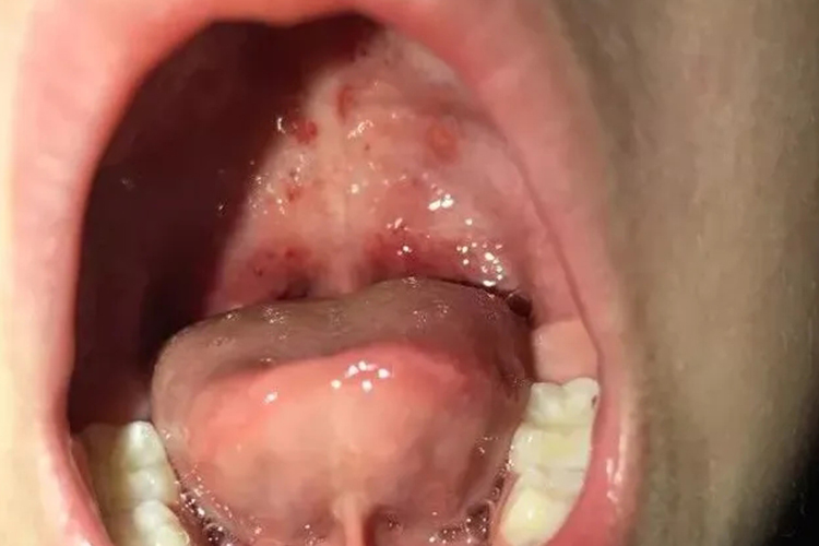 咽喉带状疱疹图 咽喉带状疱疹图