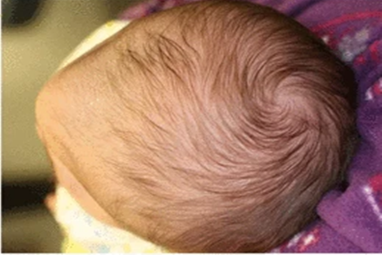 婴儿三角头畸形图