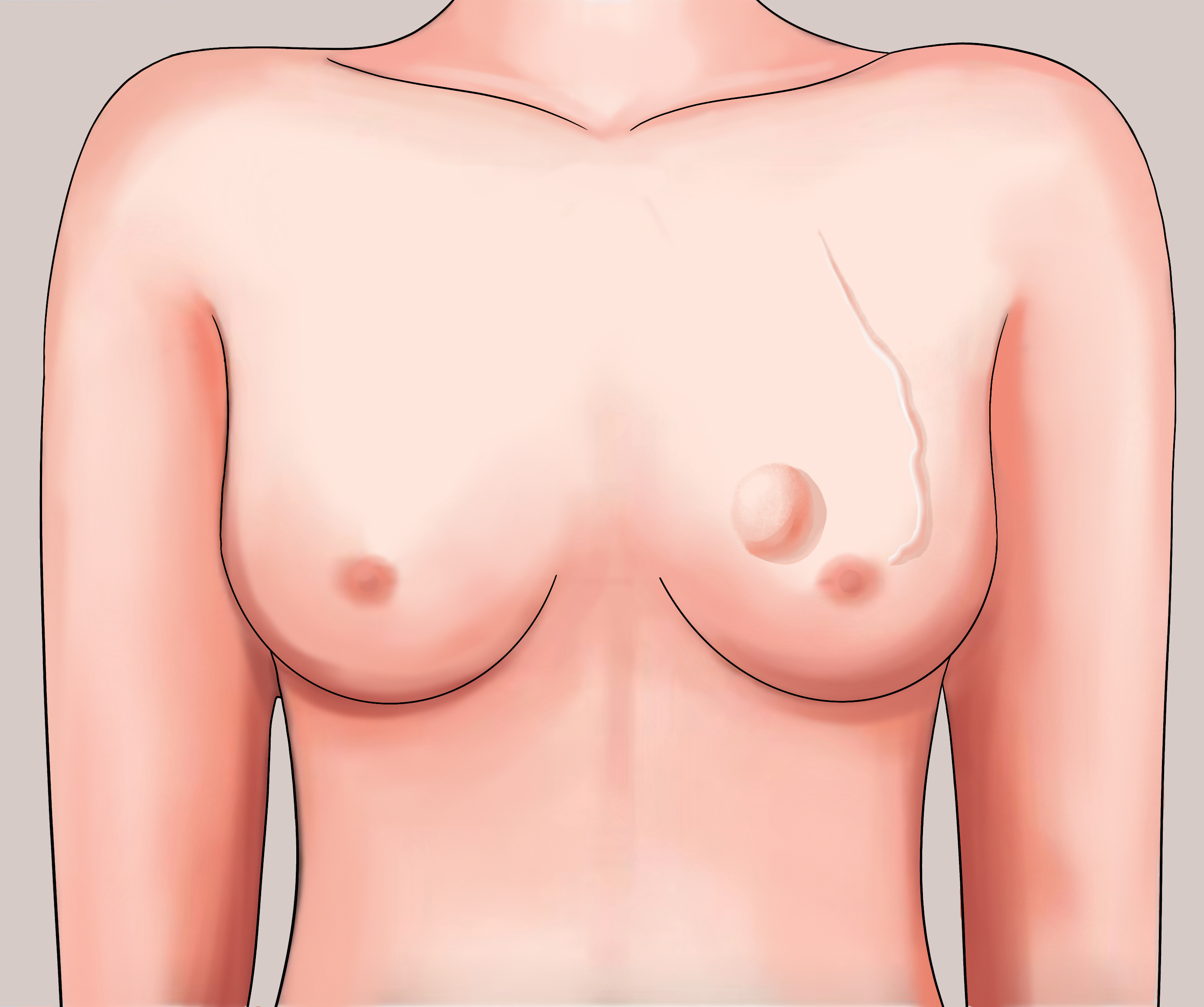 乳腺纤维腺瘤浅表静脉怒张图